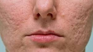 Acne and scar treatment Singapore