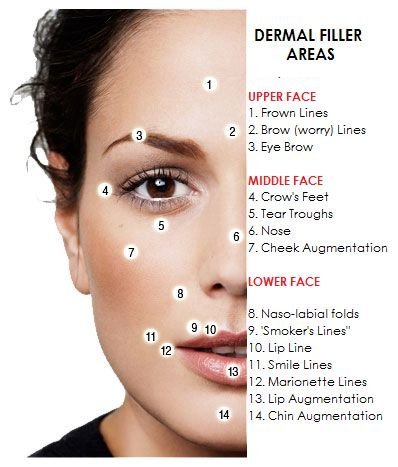 Dermal filler injection Singapore