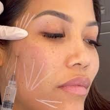 PLLA collagen biostimulator treatment Singapore